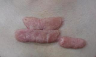 瘢痕疙瘩吧 瘢痕疙瘩吧